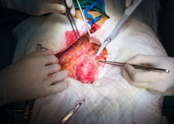 Aneurisma dell’Arco Aortico, paziente salvato al Moscati di Avellino