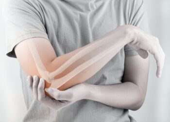 (H) Open Day osteoporosi al Vanvitelli di Napoli