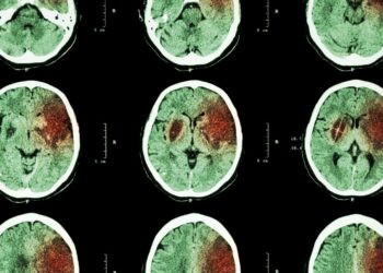 Ictus, al Ruggi di Salerno percorsi pazienti covid-19