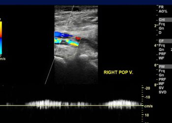 Trombosi e vaccini anti covid-19, il Rapporto dell’AIFA