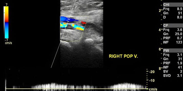 Trombosi e vaccini anti covid-19, il Rapporto dell’AIFA