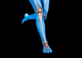 Al Policlinico Vanvitelli di Napoli, trapianto innovativo di emipiatto tibiale