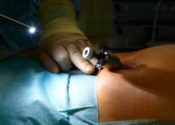 AORN Moscati di Avellino, primi interventi con la tecnica mininvasiva V-Notes