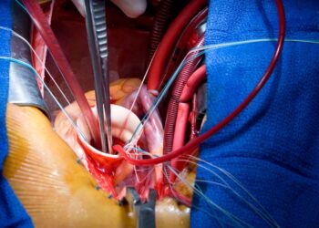 AOU Federico II di Napoli, primo intervento in Italia di chirurgia mini-invasiva al cuore