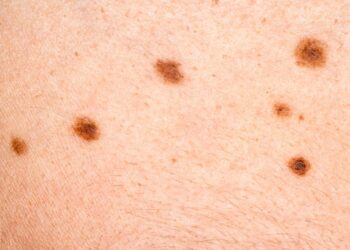 Ascierto co-autore di un libro sul melanoma dell’Esmo