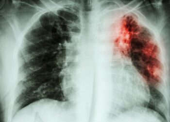 Fibrosi polmonare idiopatica, nuovi studi della Fondazione San Gerardo di Monza