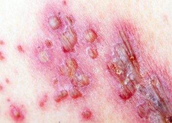 Herpes Zoster, il 28 febbraio open day vaccinazione al Moscati di Avellino