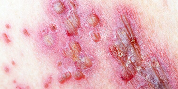 Herpes Zoster, il 28 febbraio open day vaccinazione al Moscati di Avellino