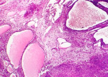 Il Pascale nello studio internazionale sul cancro