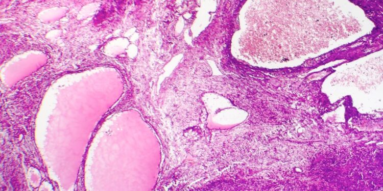 Il Pascale nello studio internazionale sul cancro