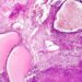 Il Pascale nello studio internazionale sul cancro