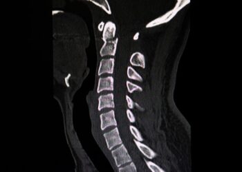 Intervento d’eccellenza al Ruggi di Salerno