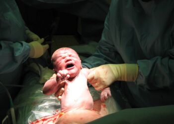 Ospedale di Frattamaggiore, crollato il numero di parti cesarei su primo figlio