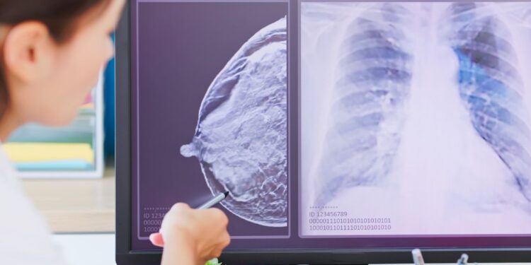 Policlinico di Bari, un software per la diagnosi precoce del cancro al seno