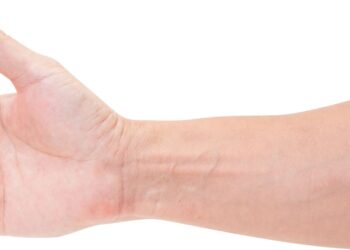 Policlinico di Palermo, reimpianto di un braccio per la prima volta in Sicilia