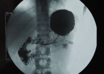 Policlinico Federico II di Napoli, rimosso un voluminoso diverticolo di Zenker