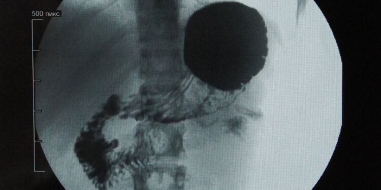 Policlinico Federico II di Napoli, rimosso un voluminoso diverticolo di Zenker