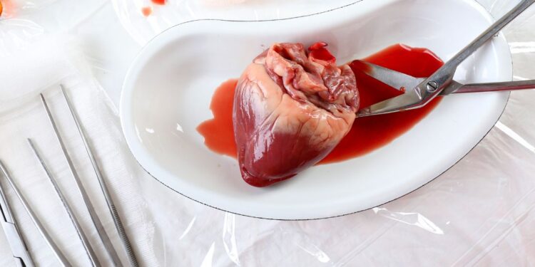 Trapianto di cuore in urgenza al Monaldi salva la vita ad una 41enne