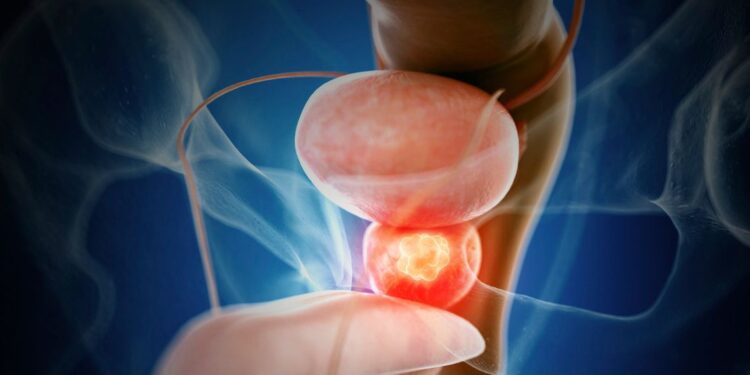 Tumori della prostata, polmone e colon, identificati nuovi marcatori per individuarli