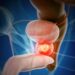 Tumori della prostata, polmone e colon, identificati nuovi marcatori per individuarli