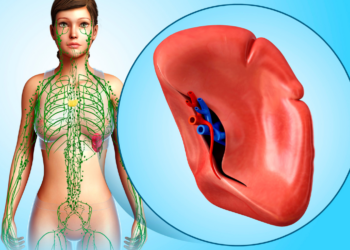 Resezione parziale della milza con patologia rara: al San Gerardo uno dei pochi casi eseguiti al mondo