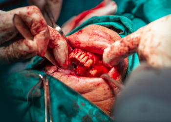 Tumori maxillo-facciali, Gianpaolo Tartaro: “Dopo la pandemia aumento del 60% dei casi ed età media passata da 70 a 55 anni”