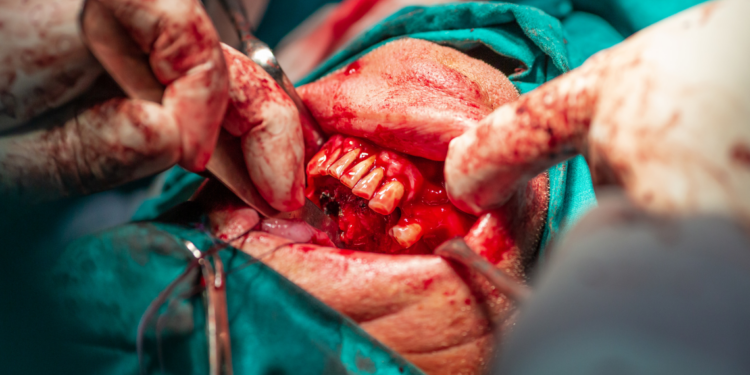 Tumori maxillo-facciali, Gianpaolo Tartaro: “Dopo la pandemia aumento del 60% dei casi ed età media passata da 70 a 55 anni”