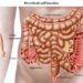 Patologie del colon, due milioni per endoscopia digestiva