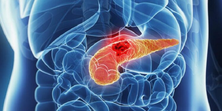 Cancro del pancreas. Gruppo di ricerca veronese scopre un nuovo bersaglio per il trattamento della malattia avanzata La prestigiosa rivista Cancer Research ha pubblicato i risultati dello studio
