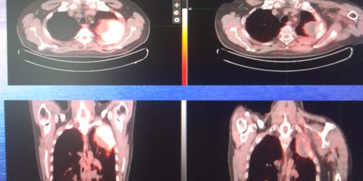 Tecnica innovativa di radioterapia al Ruggi di Salerno. In remissione un tumore di  grosse dimensioni  su un paziente.