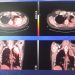 Tecnica innovativa di radioterapia al Ruggi di Salerno. In remissione un tumore di  grosse dimensioni  su un paziente.