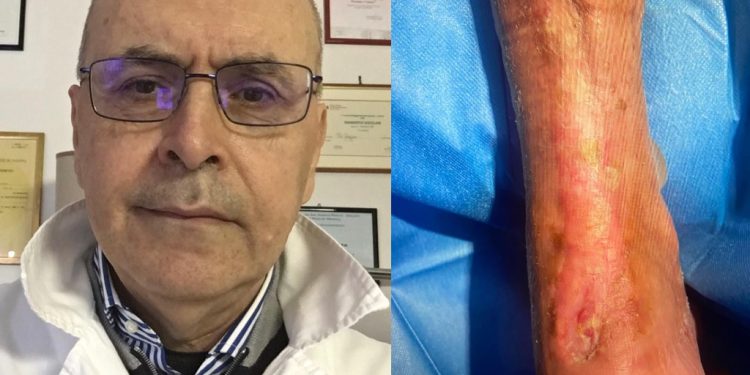 Trapianto di tendine da cadavere effettuato su un paziente di 70 anni di Salerno all’ospedale di Oliveto Citra dell’ ASL Salerno