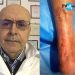 Trapianto di tendine da cadavere effettuato su un paziente di 70 anni di Salerno all’ospedale di Oliveto Citra dell’ ASL Salerno