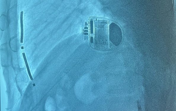 Primo impianto di ICD extravascolare all’IRCCS Policlinico San Matteo di Pavia