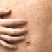 Morbillo in lieve aumento