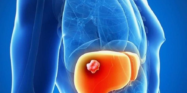 La cura per la Colangite biliare primitiva rischia di non essere più disponibile per i pazienti