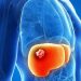 La cura per la Colangite biliare primitiva rischia di non essere più disponibile per i pazienti