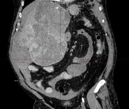 Chirurgia epatica estrema al Policlinico di Bari: rimosso tumore di 5 kg