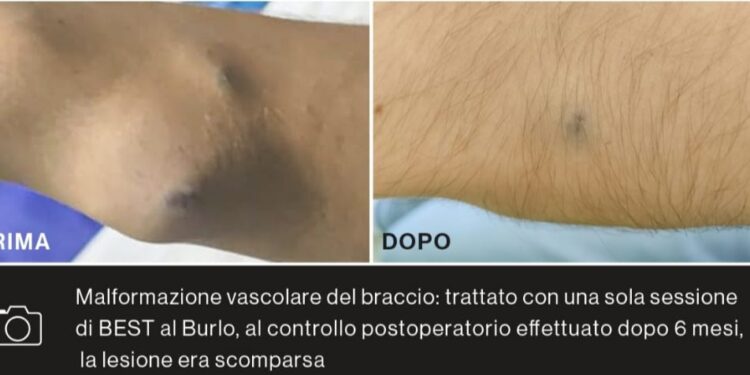 Nuovo trattamento per le malformazioni vascolari pediatriche Grazie a uno studio condotto al Burlo di Trieste, la tecnica BEST si prepara a diventare il nuovo standard di riferimento in pediatria