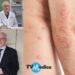 Il 29 ottobre è la Giornata mondiale della Psoriasi, una patologia troppo spesso sottovalutata che in Italia colpisce circa 1,8 milioni di persone, di cui 150.000 in forma severa