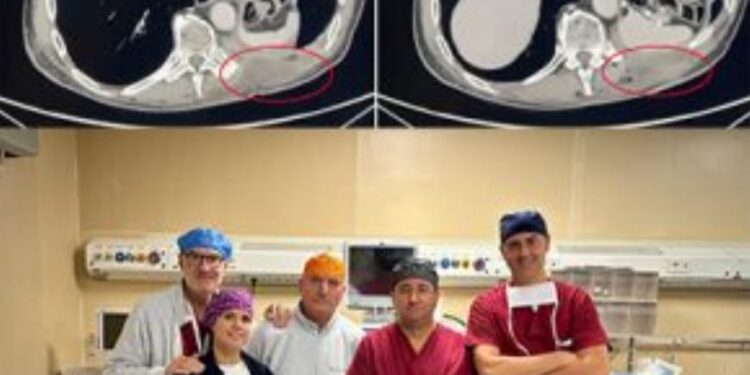 Ospedale Mazzini, innovativo intervento su tumore polmonare Sinergia fra le unità di Chirurgia toracica e Plastica-ricostruttiva