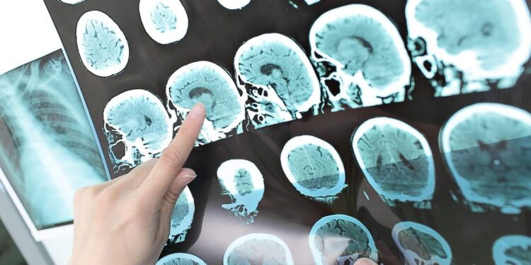 Allenare il cervello per rallentare il declino cognitivo: come corpo e mente agiscono sull’infiammazione