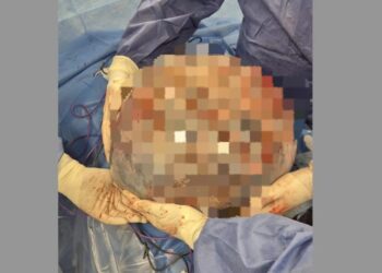 Asportata una massa ovarica di oltre 50 centimetri.Occupava l’intero addome, arrivando fino al diaframma e comprimendo gli organi interni