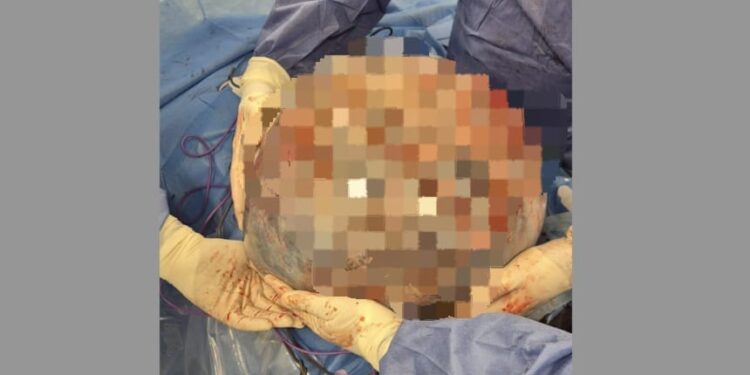 Asportata una massa ovarica di oltre 50 centimetri.Occupava l’intero addome, arrivando fino al diaframma e comprimendo gli organi interni