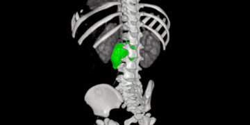 BAMBINO GESÙ: NUOVA STRATEGIA CHIRURGICA INTEGRATA PER RIMUOVERE UN COMPLESSO NEUROBLASTOMA