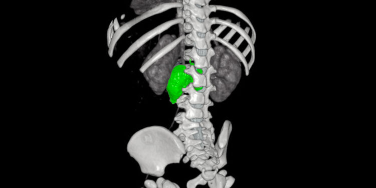 BAMBINO GESÙ: NUOVA STRATEGIA CHIRURGICA INTEGRATA PER RIMUOVERE UN COMPLESSO NEUROBLASTOMA
