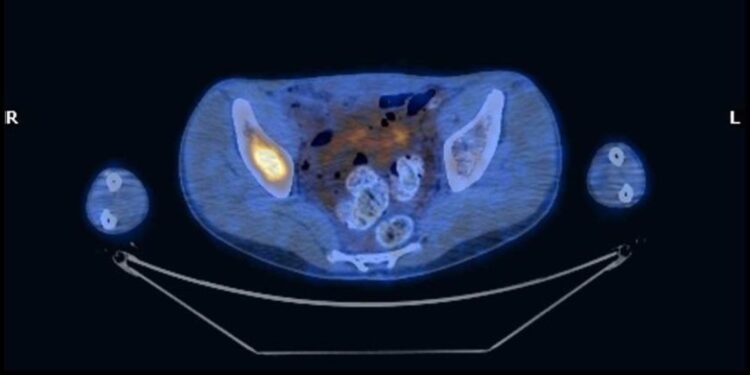ONCOEMATOLOGIA PEDIATRICA, RABDOMIOSARCOMA: IL PRELIEVO DI MIDOLLO PUÒ ESSERE EVITATO IN FASE DIAGNOSTICA. UN NUOVO STUDIO SULL’UTILIZZO ALTERNATIVO DELLA PET