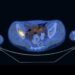 ONCOEMATOLOGIA PEDIATRICA, RABDOMIOSARCOMA: IL PRELIEVO DI MIDOLLO PUÒ ESSERE EVITATO IN FASE DIAGNOSTICA. UN NUOVO STUDIO SULL’UTILIZZO ALTERNATIVO DELLA PET