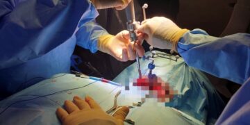 Eseguito il primo intervento in Italia di artrodesi cervicale posteriore percutanea con neuronavigazione al San Filippo Neri di Roma